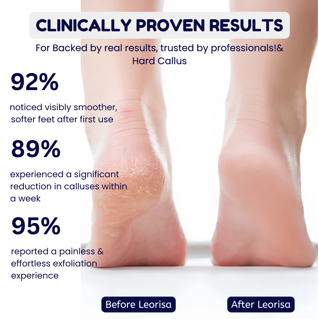 Leorisa Electric Callus Remover
